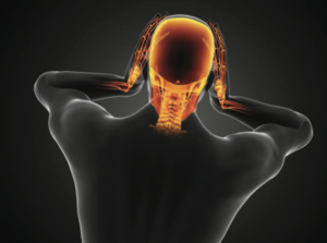 Cervicogenic Headaches A Pain In The Neck Upstream